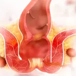 Pomata per emorroidi: alcuni consigli per lenire prurito e bruciore