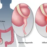 Appendicite: sintomi, cause, cure
