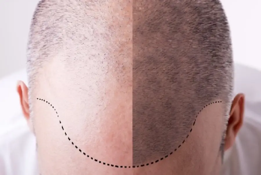 Tricopigmentazione permanente o semi permanente? Differenze e consigli