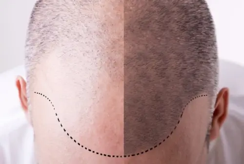 Tricopigmentazione permanente o semi permanente? Differenze e consigli