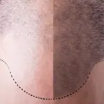 Tricopigmentazione permanente o semi permanente? Differenze e consigli