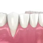 Gengive ritirate, cosa sono e come intervenire